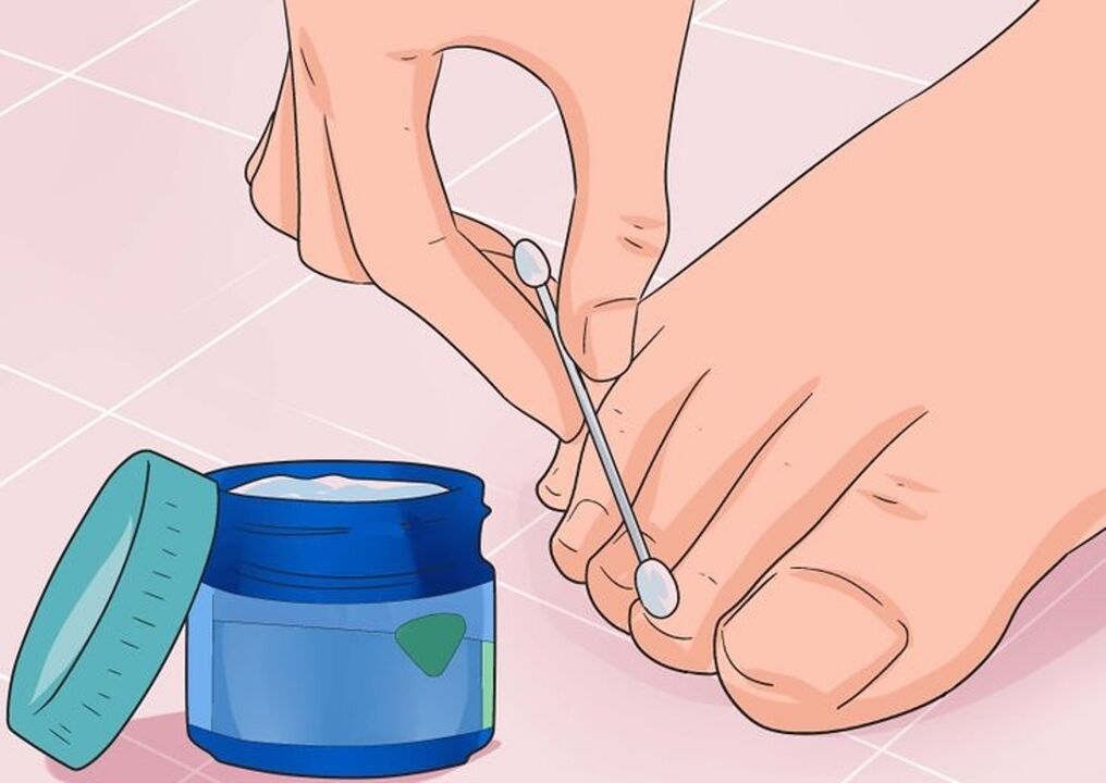 Guérisser les champignons à ongles