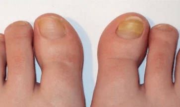 La phase initiale du champignon des ongles