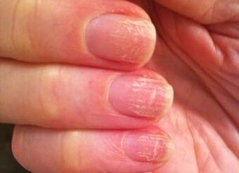 La phase initiale du champignon sur les ongles