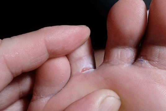 L'apparition de formations de la vessie sur les pieds
