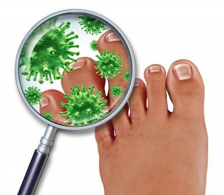 Infection fongique sur les pieds