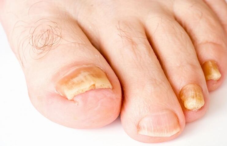 Ongles jaunes à cause de champignons