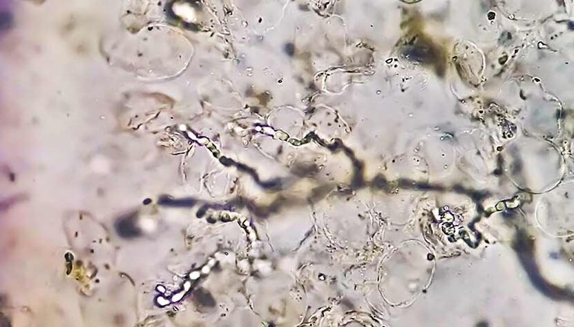 Champignons au microscope - la cause des mycoses des pieds